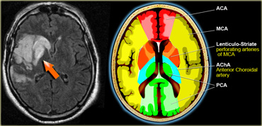 MCA infarction. Involvement of cortical branches and deep perforating lenticulo-striate arteries